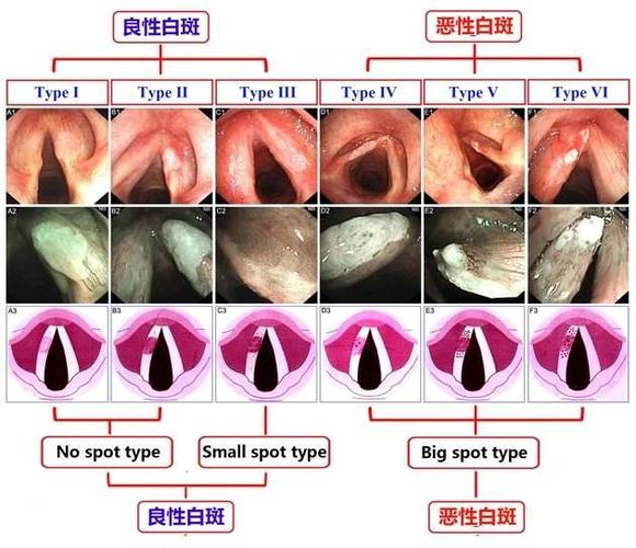 nbi电子鼻咽喉镜__早期喉部肿瘤的透视镜
