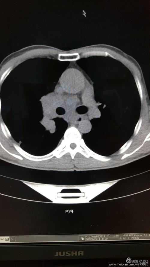 冯xx男51岁五官科诊咽炎,咳嗽行胸片常规检查,发现右下肺占位,ct同诊