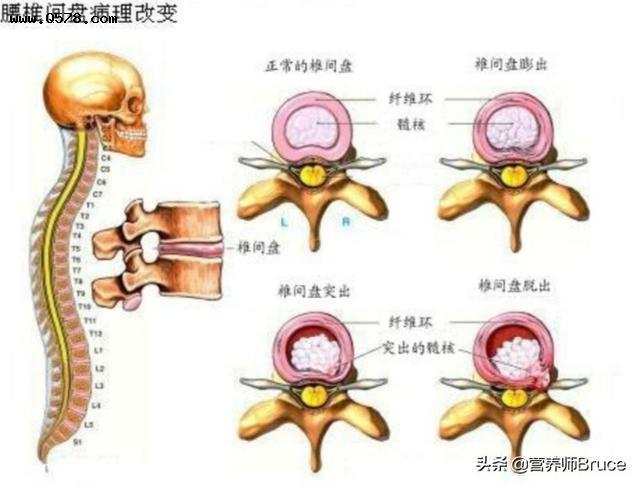 腰椎l3-l4膨出,l4-l5突出,l5-s1脱出是什么意思?