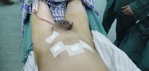 左侧巨大阴囊疝一例