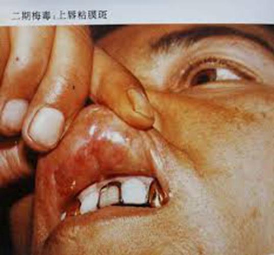 早期梅毒感染症状图图片