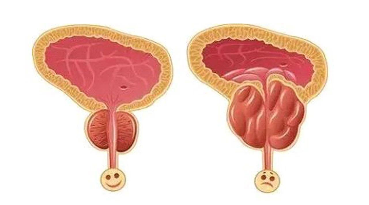 前列腺疾病是成年男性的常见疾病,通常指前列腺炎,前列腺增生及前列