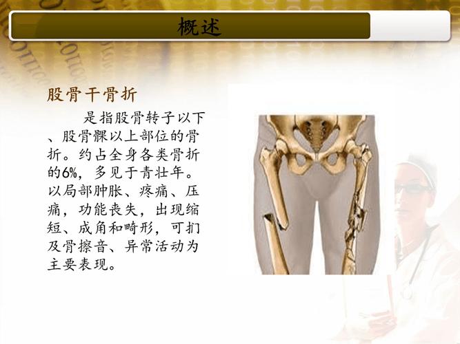 股骨干骨折教学查房课件