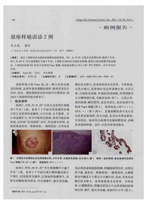 期刊报告2例曾误诊为湿疹和股癣的湿疹样癌.