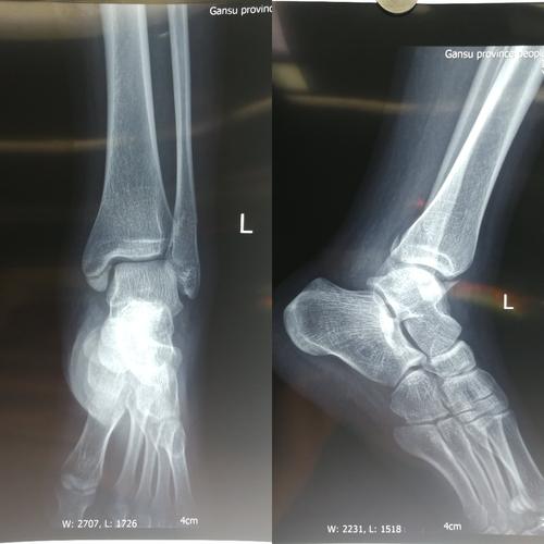 甘肃省人民医院骨一科杨青山副主任医师团队:踝关节骨折