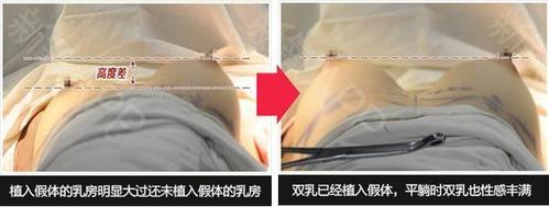 隆胸,你适合多大的假体?