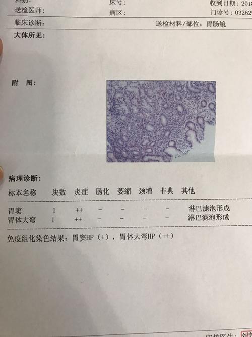 做胃镜活检结果单 谁帮我看一下有没有大碍
