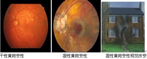 病专科 > 视网膜疾病       湿性老年性黄斑变性还可以分为两种类型