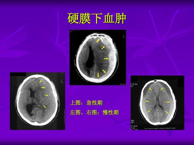 临床医学 如何分析脑ct(同济大学)ppt  硬膜下血肿 上图:急性期 左图