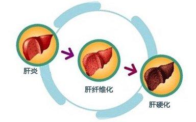 肝炎可以分急性和慢性肝炎,按照肝炎病毒可以分为甲型肝炎