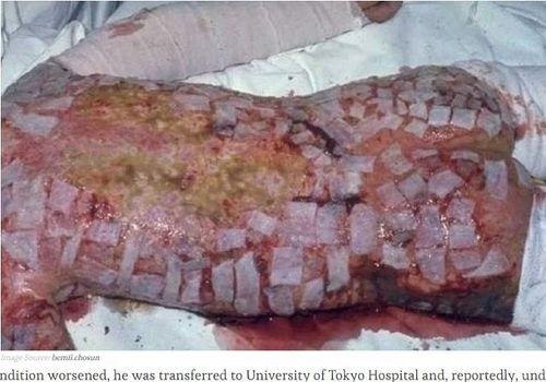 东海村核临界事故遇难者接受救治资料图 图片来自日本互联网中国核