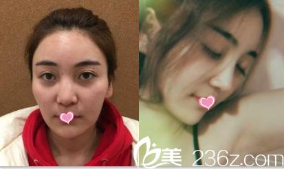 北京叶美人姚明龙鼻修复案例