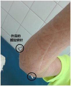 "儿童最易出现的骨折"肱骨髁上骨折是怎么回事?