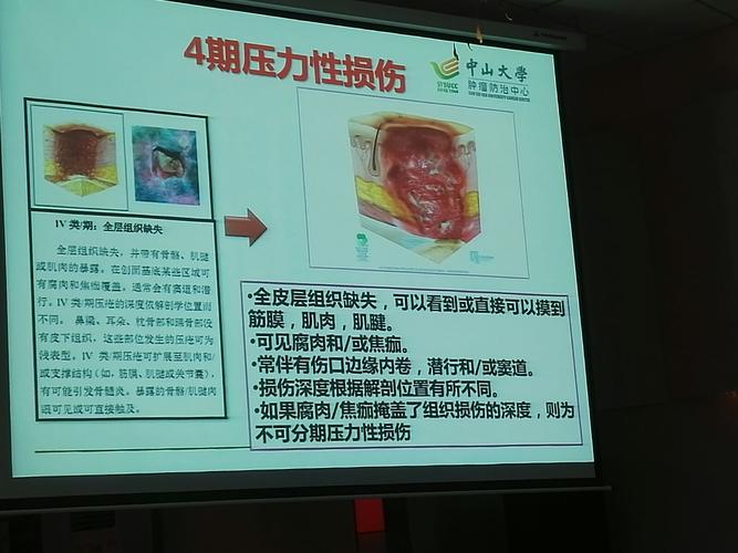 一,压力性损伤的分期及预防二,压力性损伤与失禁性皮炎的区别