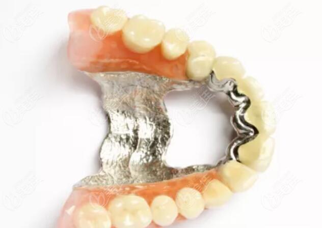 做义齿用hpp支架和纯钛支架哪个好材质直接决定两者区别大不同