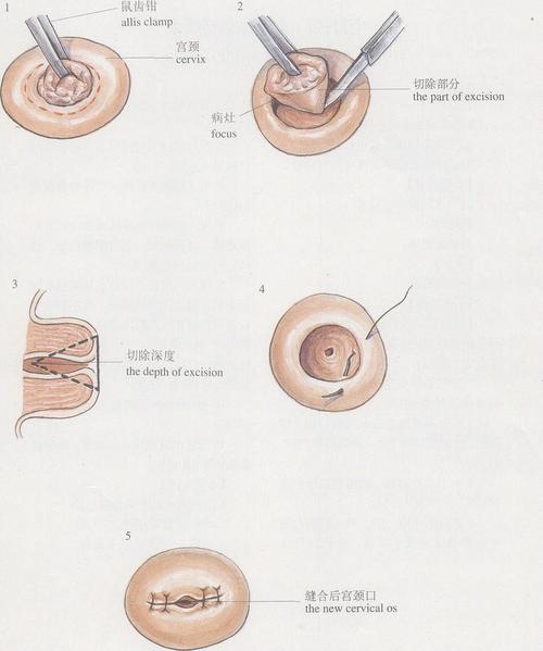 (图) 宫颈锥形切除术