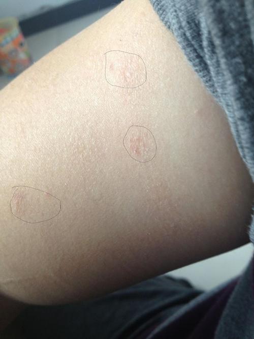 皮肤性病科 性病科 艾滋病 → 这是不是艾滋病初期皮疹?