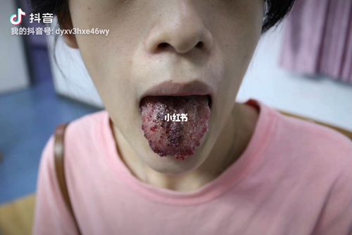 舌部血管瘤带给我们诸多不便_医疗健康_医疗健康其他