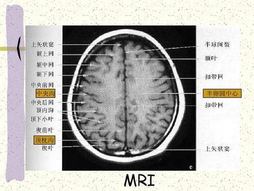 颅脑断面解剖-好ppt