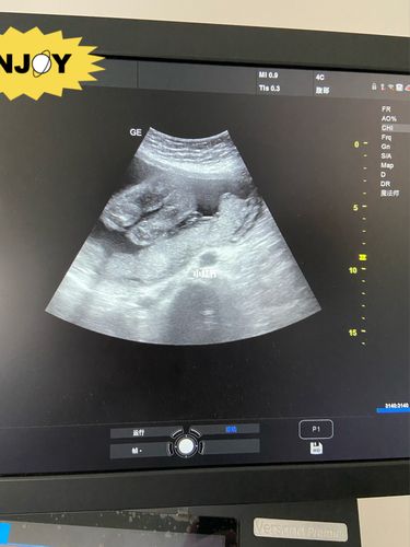 五个多月b超图,有没有大神会看男女呀～_b超_b超单猜男女_母婴_孕产