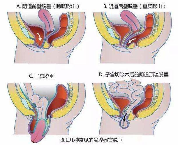 3器官脱垂:出现轻度的子宫脱垂,膀胱脱垂,直肠脱垂.