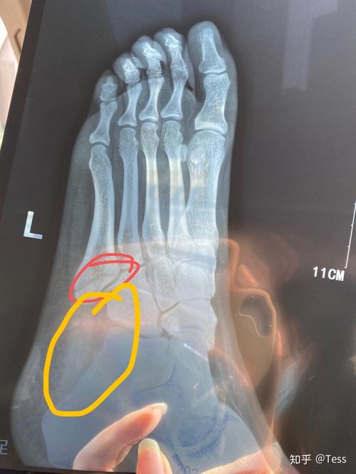 左足第五跖骨基底部骨折