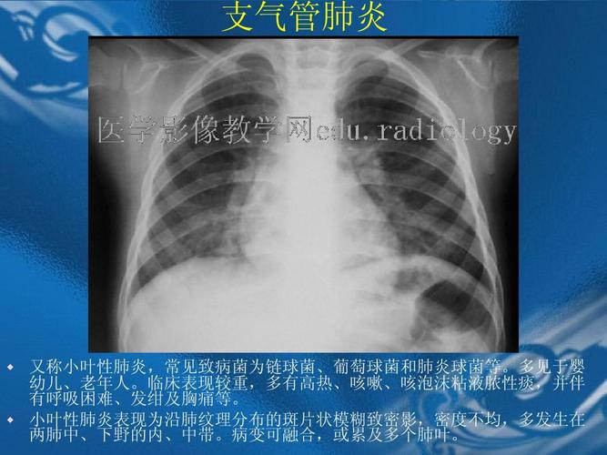 小叶性肺炎表现为沿肺纹理分布的斑片状模糊致密影,密度不均,多发