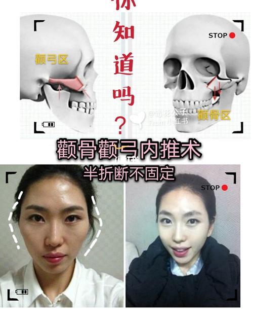 颧骨篇关于颧弓颧骨内推术半折断不固定