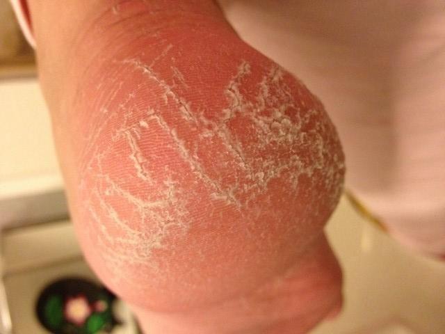 脚后跟出现干裂,这两件事一定要停止了!快群发