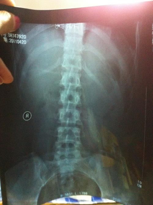 拍了片子,骨头无伤,脊椎正常,医生只让静养.可是疼.