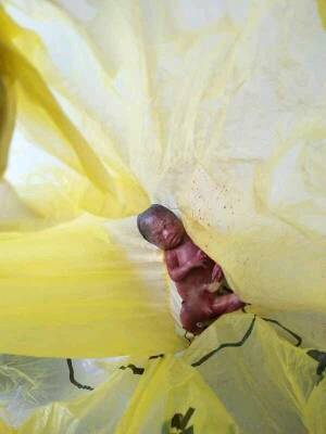 724高风险,后来又做羊水穿刺,结果21三体染色异常,后来宝宝引产出来