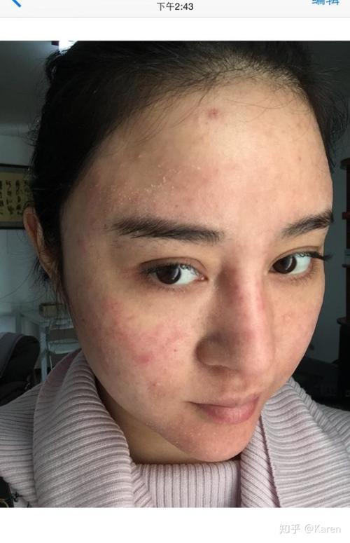 湿疹皮炎激素脸请进