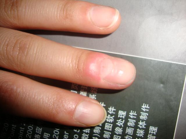 手指尖红肿多年怎么治