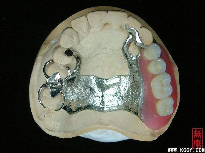 如何选择假牙材料