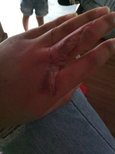 吓唬人的手受伤图片