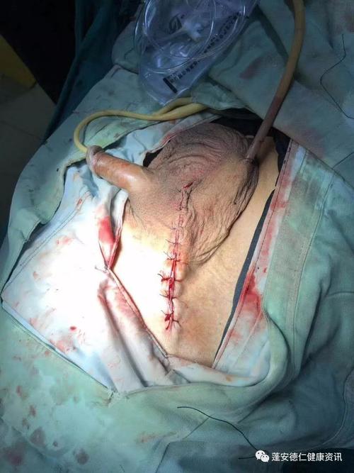 患疾40年, 罕见,罕见,如此巨大的疝!