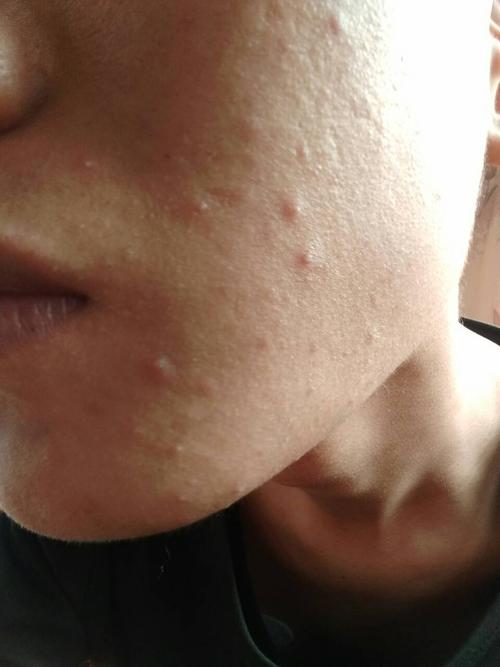 最近脸上老是冒出一些小白点,又不像青春痘,请问我应该怎么办.