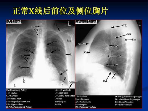 正常x线后前位及侧位胸片