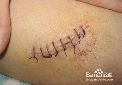 伤口缝合后注意事项