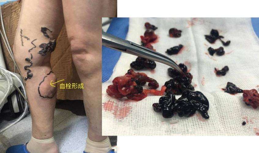 流浪的血栓更可怕中风静脉曲张可能都是它干的