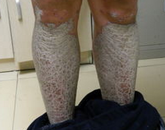 鱼鳞病最佳治疗年龄