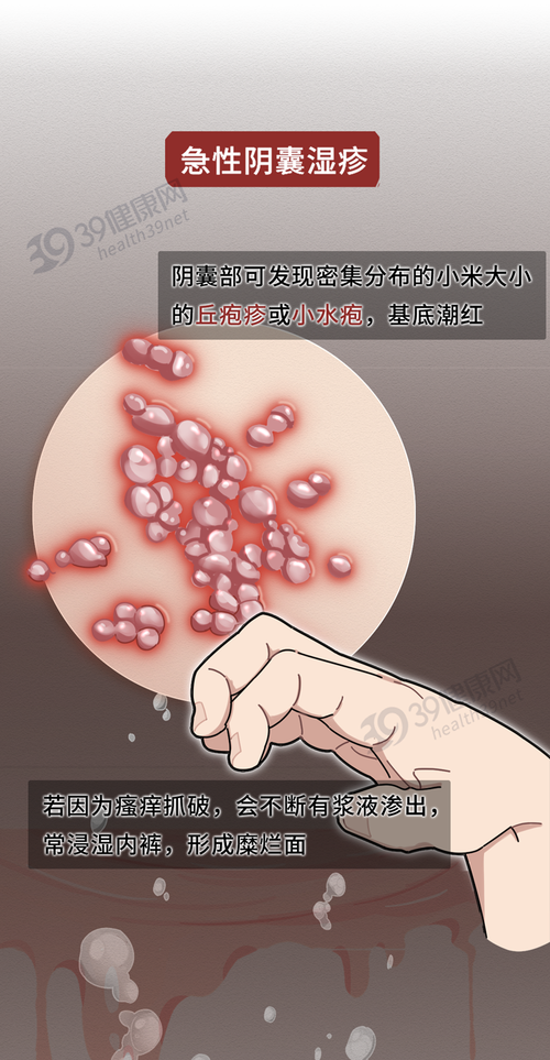 急性期,亚急性期和慢性期阴囊湿疹可以分为三期按皮肤损害的表现而且