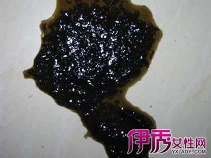 胃癌早期黑色大便图片经常拉黑便是怎么回事