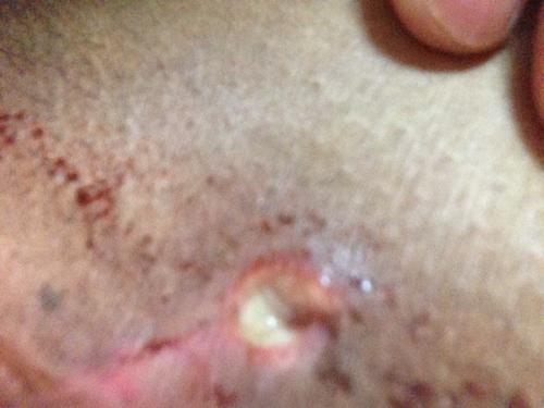 产后侧切伤口发白怎么办现在很疼求帮助