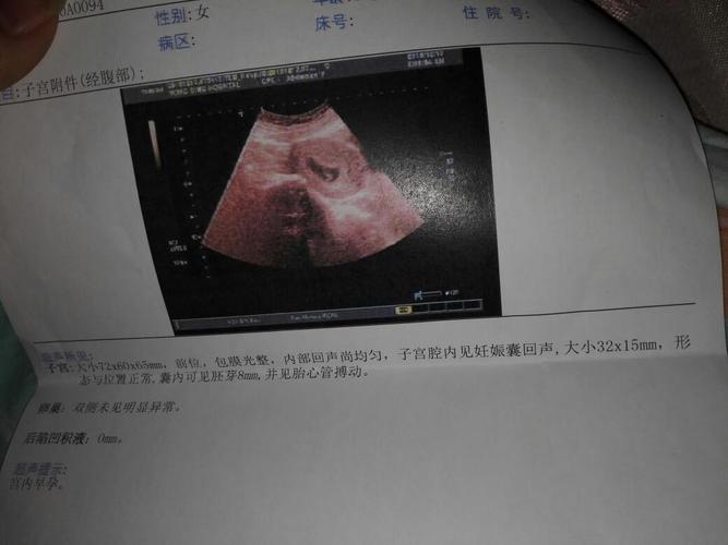 十月十八号最后一次月经,今天五十五天做的b超  孕囊大小 32*15mm