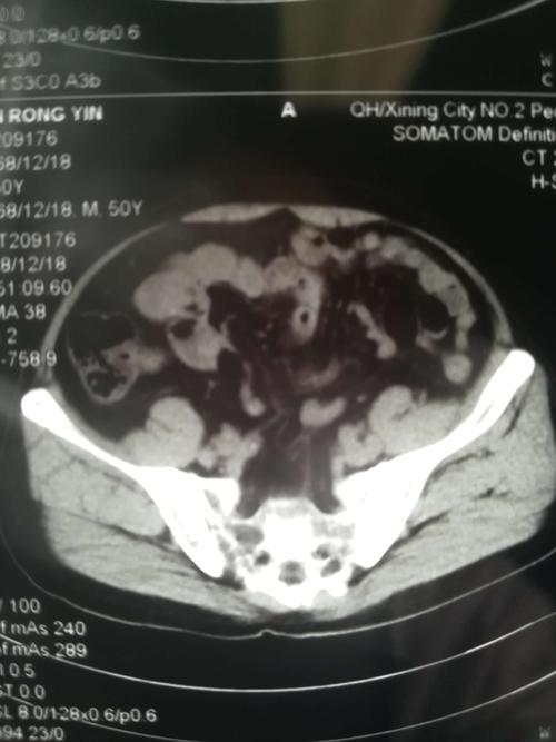 患者中老年男性,诊断:左侧腰疝