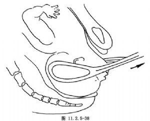 产钳术_英文_拼音_什么是产钳术_医学百科