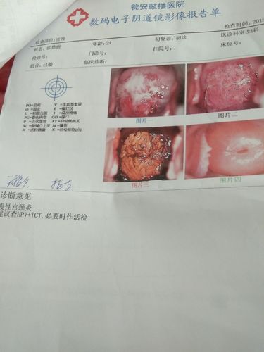 有没有宝妈像我一样的,这样的慢性宫颈炎,白带常规检查出来的