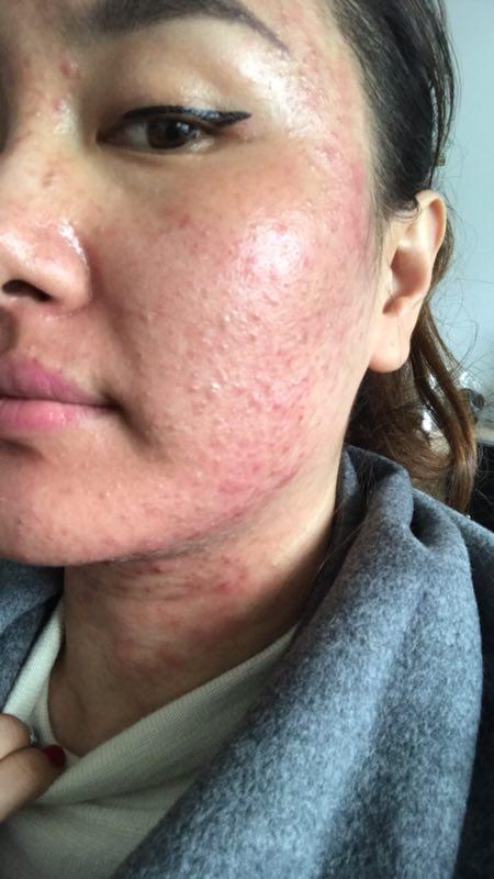 玫瑰痤疮治疗过程