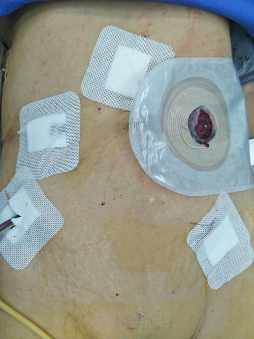 我院外一科全腹腔镜直肠癌根治术(miles手术)